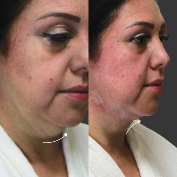 Mesoterapia Con Enzimas