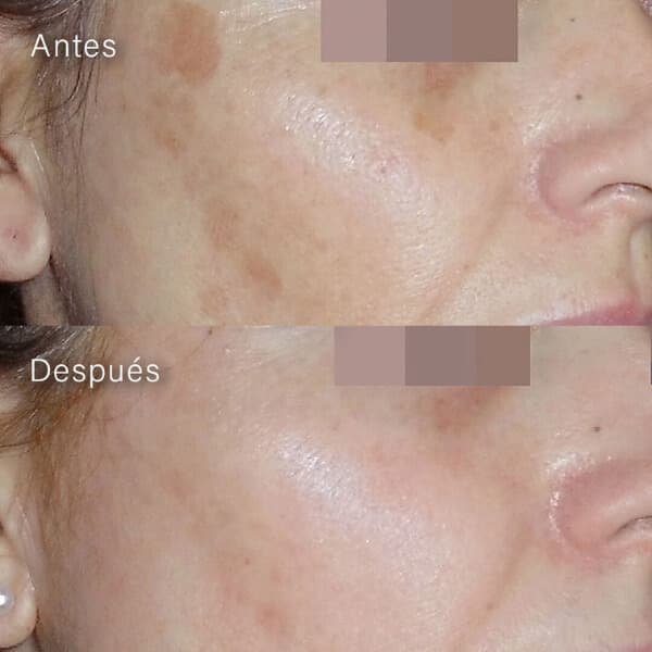 Peeling Cosmelan