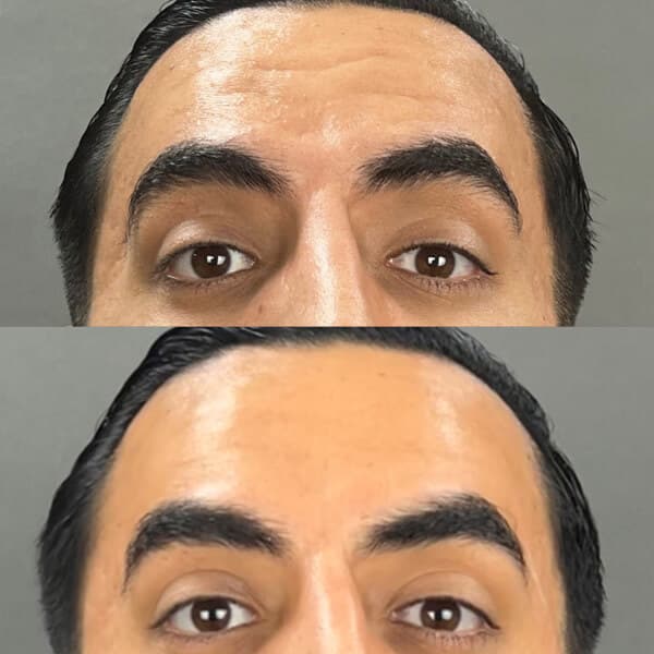 Toxina Botulínica